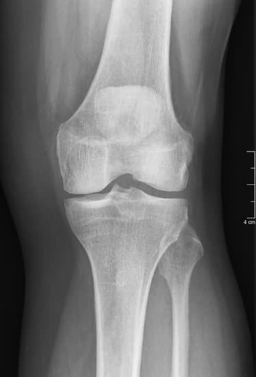 무릎 연골 이식술: 절차와 회복