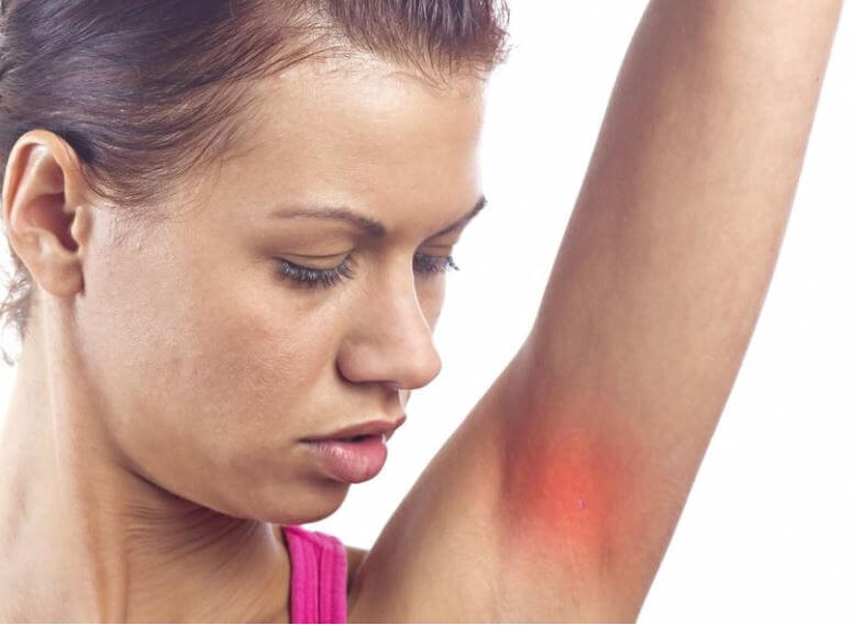 화농성 한선염 발생 부위