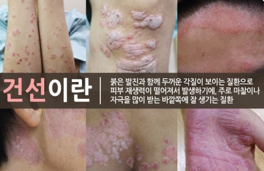 건선 원인과 증상 및 피부 변화 관련 이미지