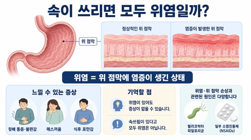 위 점막에 염증이 생기는 위염의 의미와 속쓰림만으로 위염을 판단할 수 없는 이유를 설명한 이미지