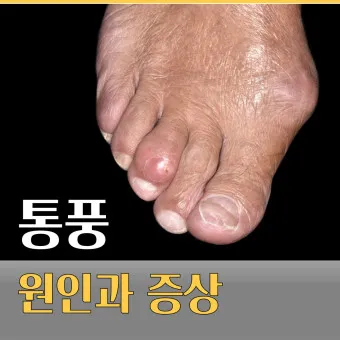 발가락 통풍 증상 및 대처방법_7