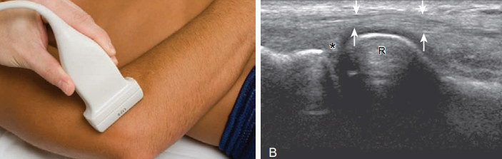 가쪽검사(lateral)
