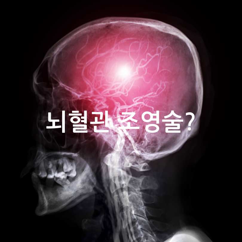 뇌혈관 조영술
