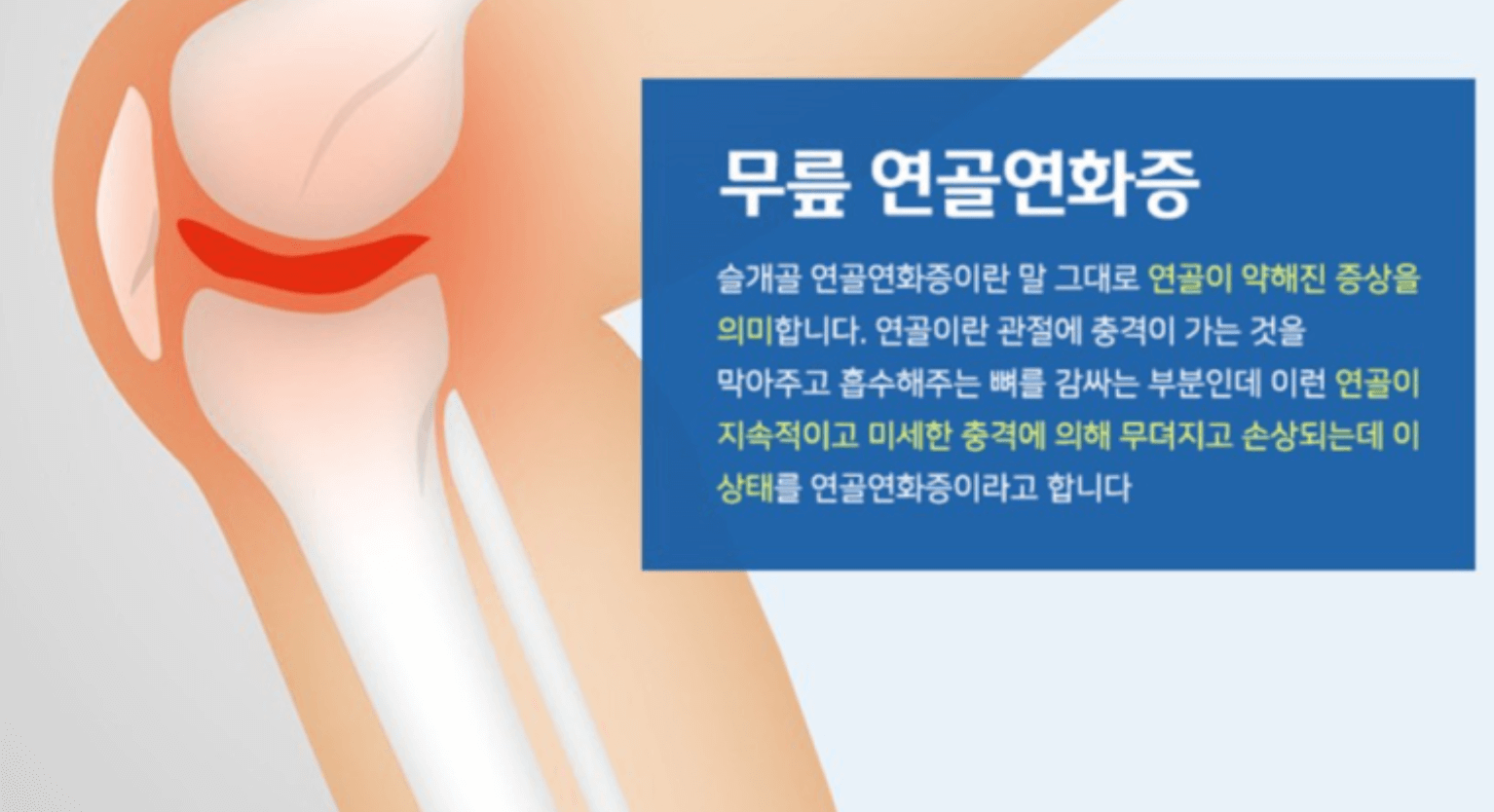 MSM과 콘드로이친