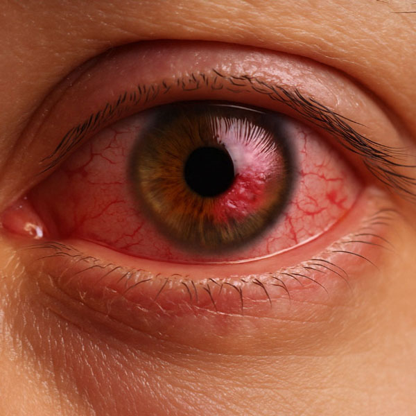 헤르페스 각막염 - 치료기간, 증상, 실명 위험