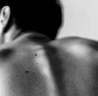 두드러기 치료방법 진단 기준 합병증