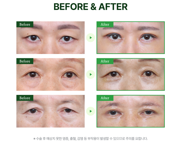 신사눈밑지방재배치 신사리프팅피부과