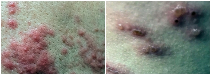 붉고 얼룩진 발진