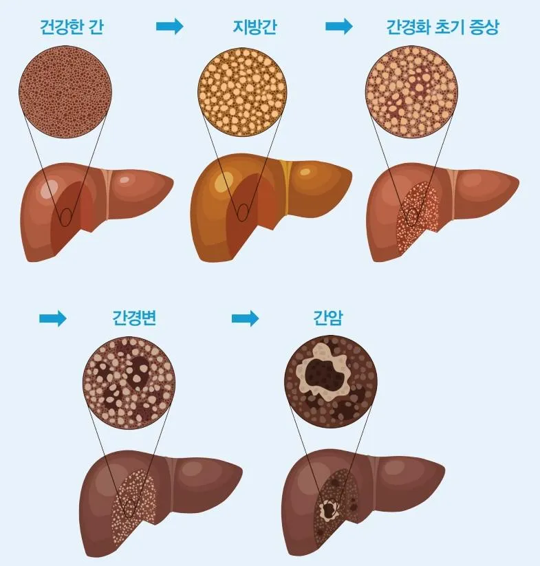 비알콜성 지방간 없애는 방법 운동 식단 중심 회복법 정리_7