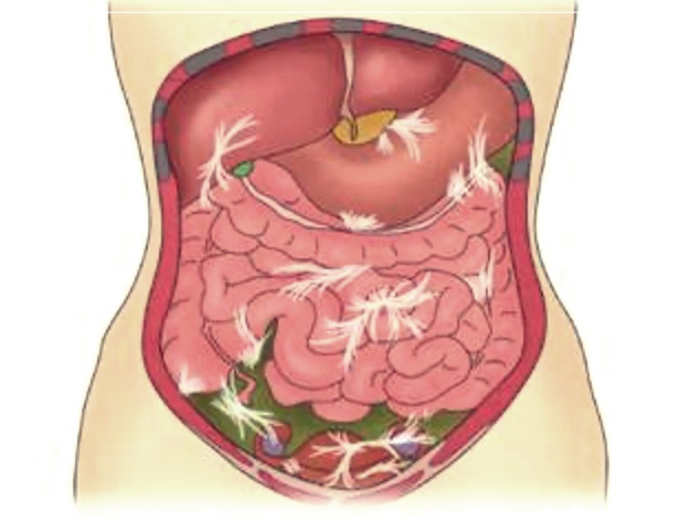 장천공 증상, 치료법 그리고 수술 후 좋은 음식에 대해