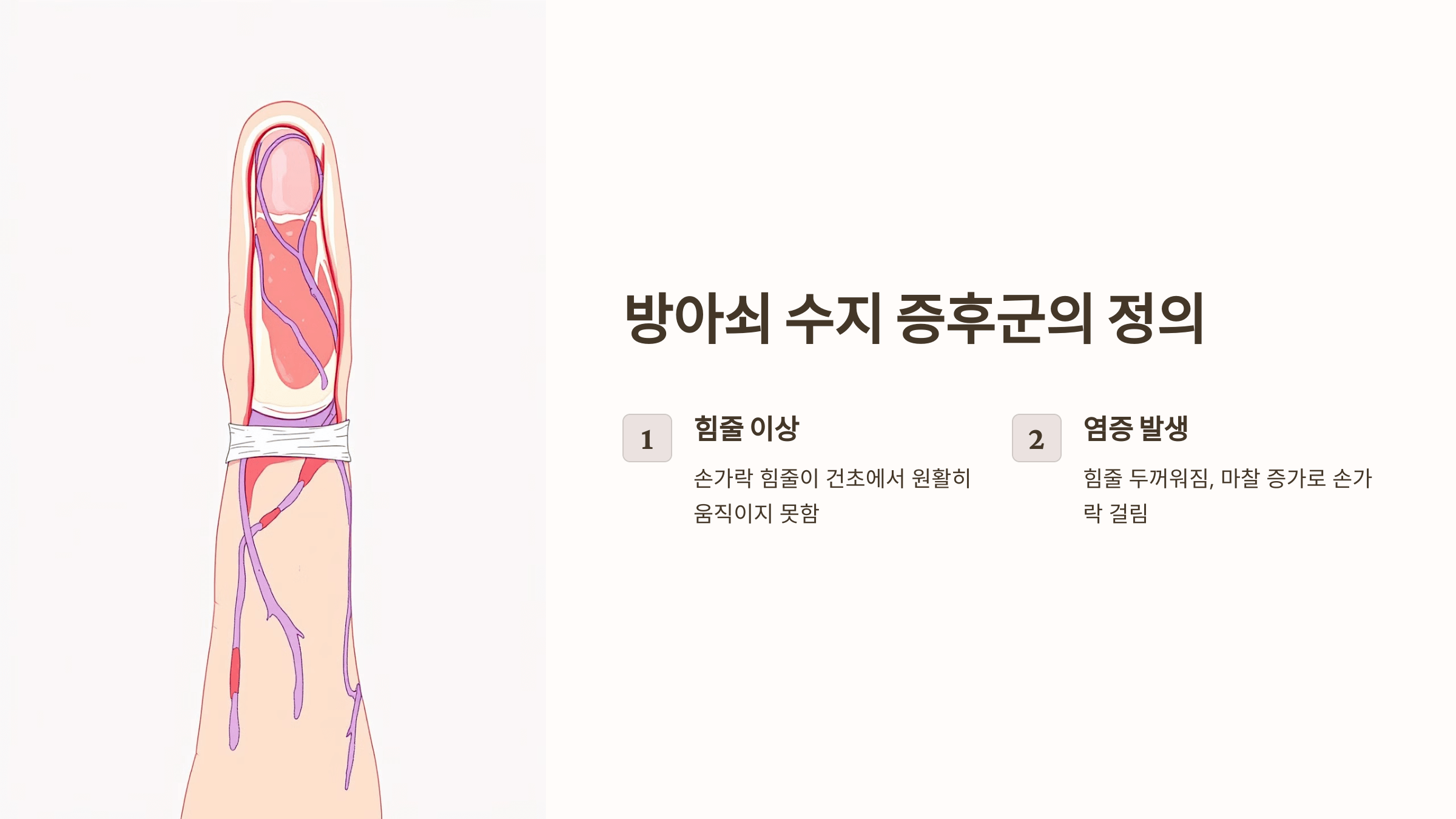 방아쇠 수지 증후군 관련된 사진입니다.