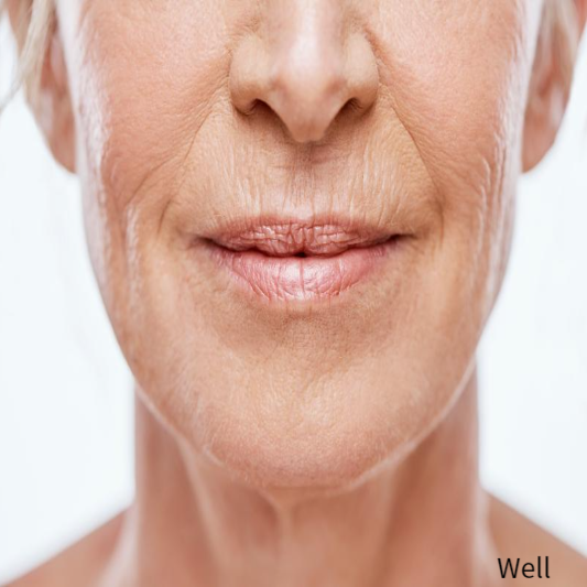 팔자주름 없애기