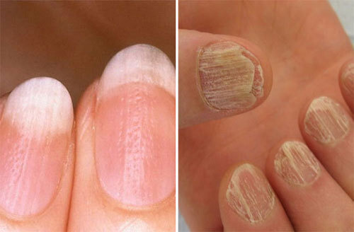 손톱으로 보는 건강상태