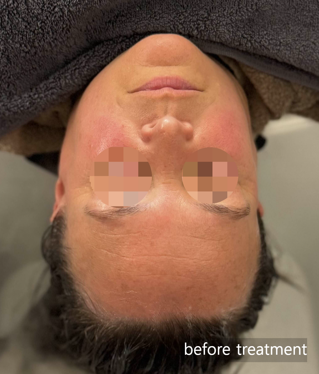Real soothing results! ✨ See how effectively we calm irritated&amp;#44; red skin and significantly reduce facial swelling. The &amp;#39;after&amp;#39; shot reveals a clear&amp;#44; rested&amp;#44; and depuffed complexion. The best part? You don&amp;#39;t have to choose between skin or scalp health. This intensive facial is performed alongside our deep scalp therapy. Plus&amp;#44; you will be resting in a state-of-the-art full-body massage chair throughout the entire session. Maximum results and total body relaxation in one visit.