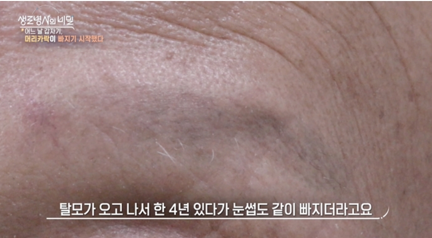 원형탈모이미지
