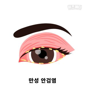 다래끼 원인