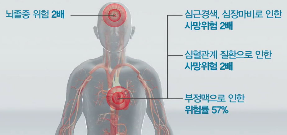 코골이와 수면무호흡으로인한 질환