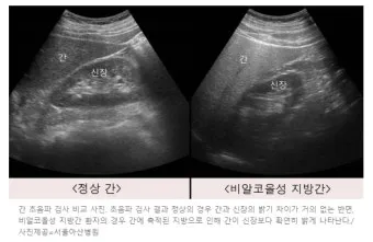 비알콜성 지방간 없애는 방법 운동 식단 중심 회복법 정리_19