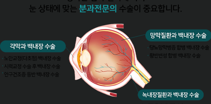 노안수술 부작용 없이 수술하는법