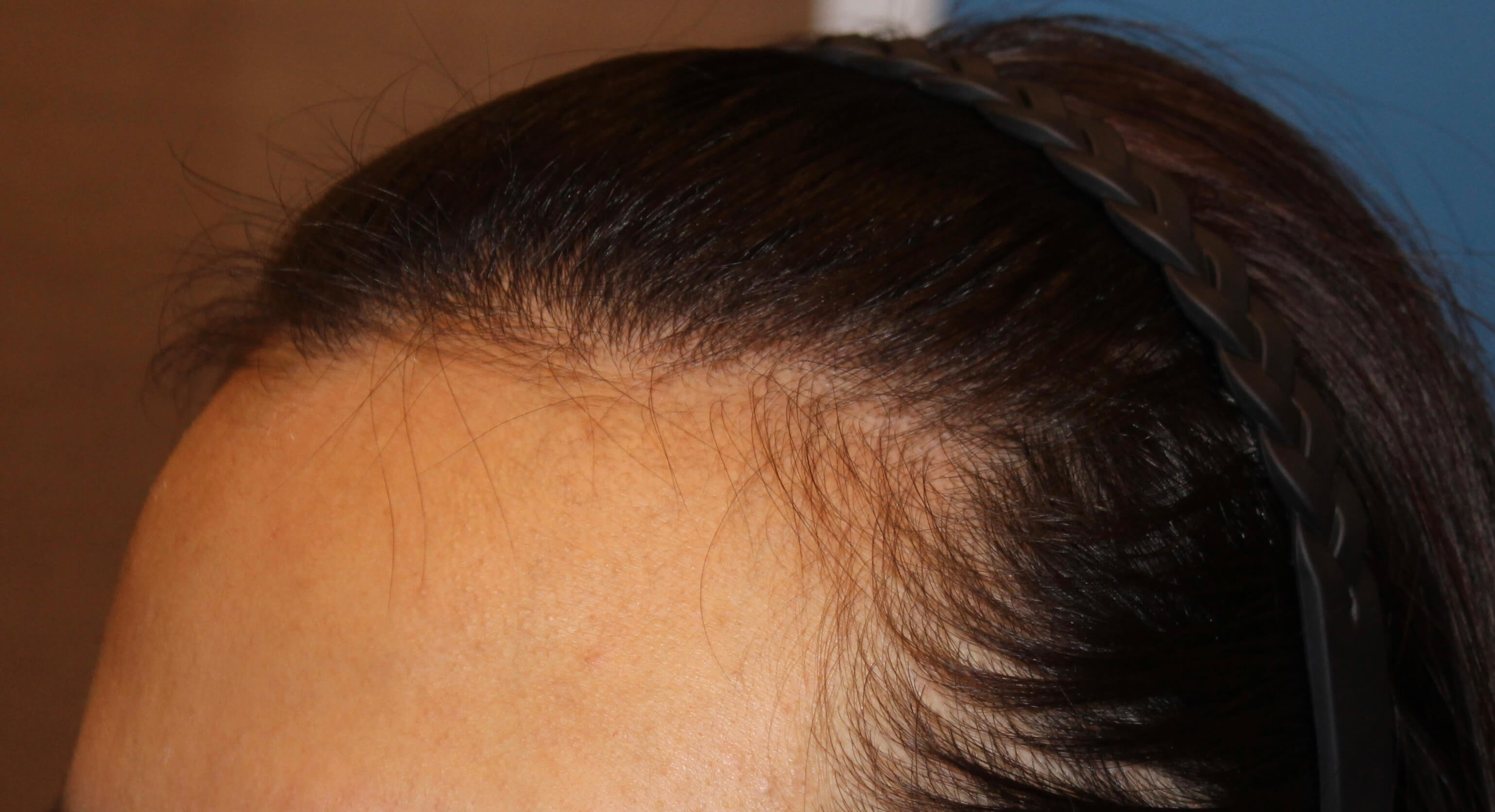 여자 헤어라인 수술 전