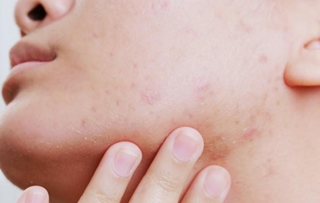 편평사마귀 없애는 방법