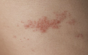 대상포진 이미지