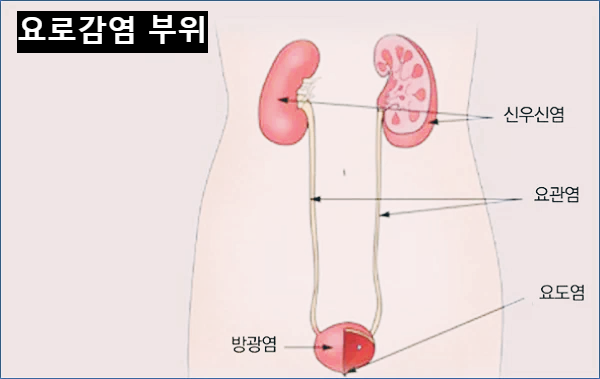 요로감염 부위