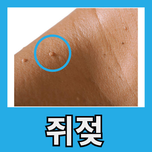 쥐젖 원인 쥐적 제거 방법 쥐젖 크기