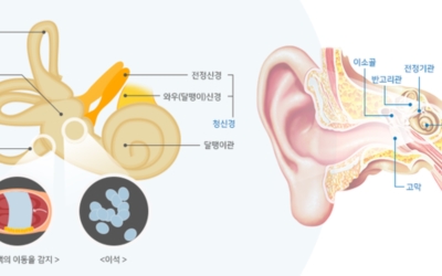 이석증이미지