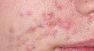 피부 트러블이 멘탈까지 무너뜨릴 때: 악순환 끊는 법