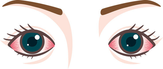 눈 실핏줄 터짐 결막하 출혈 원인 치료