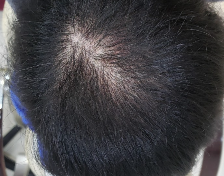 모발이식 3000모 비용 4000모 비용 부작용 과정