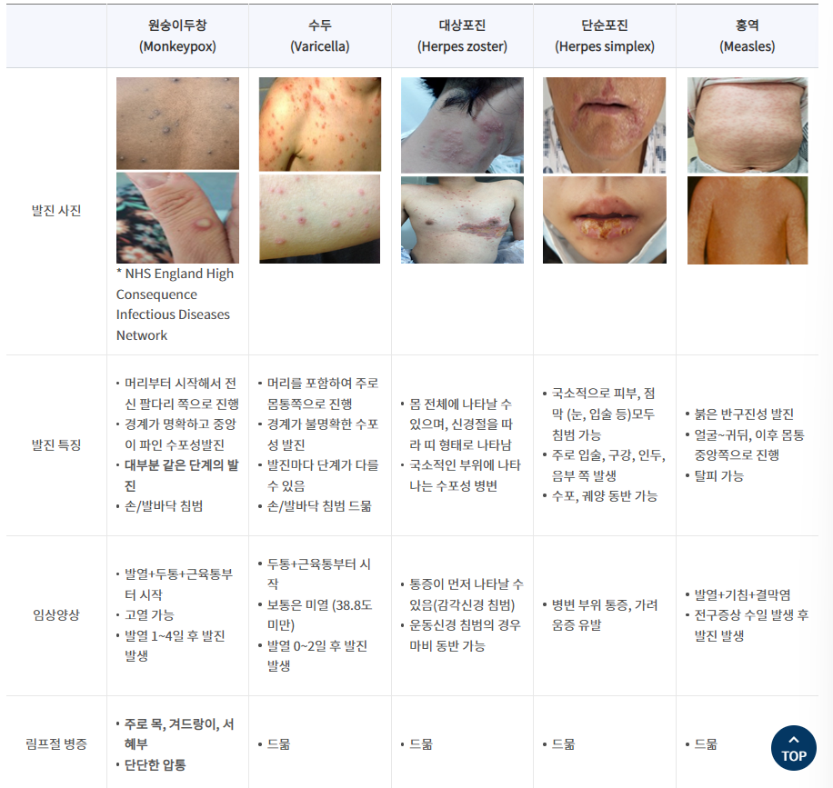 원숭이두창과 다른 피부질환의 차이점