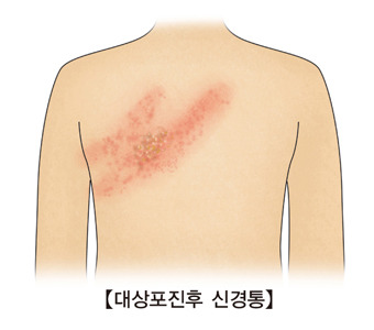 대상포진-후-신경통-고위험군-진단-치료-완치-경과