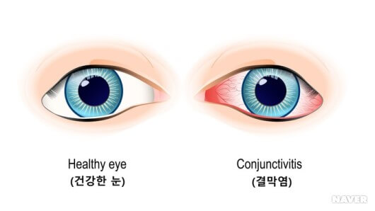 여름 유행 눈병- 유행성 결막염