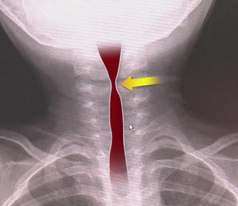 급성폐쇄성후두염 증상 진단 원인 및 치료법 정리
