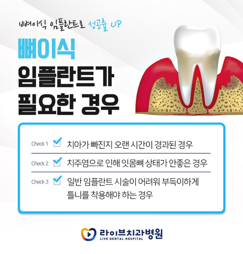 임플란트 가격 비교 사이트 추천