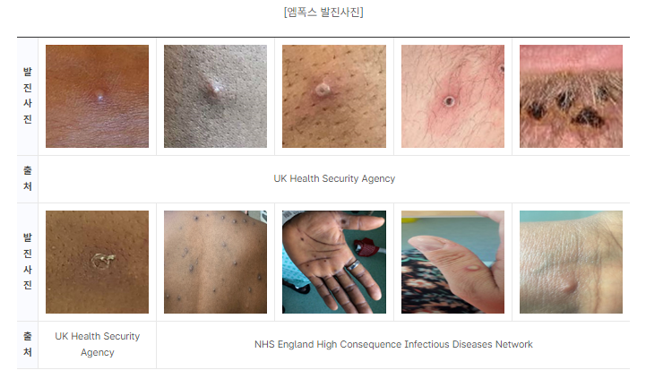 엠폭스 발진사진