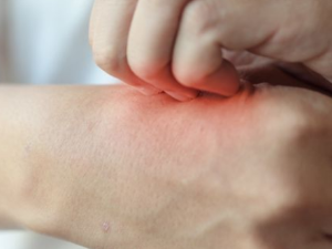 모기 물려서 가려울 때