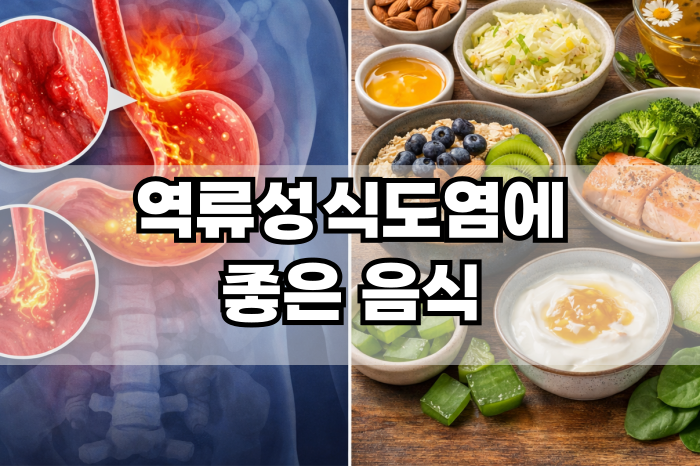 역류성식도염에 좋은 음식