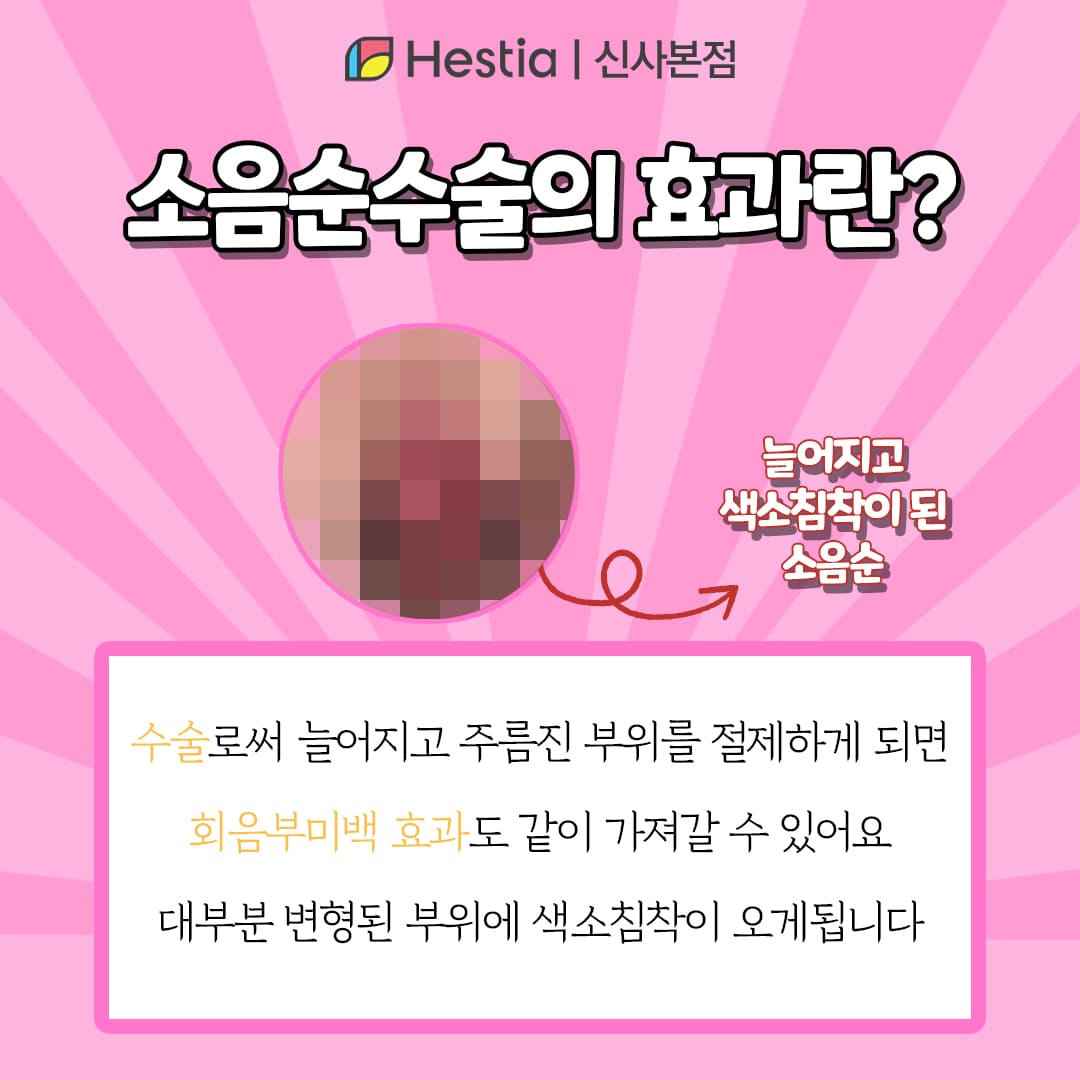 소음순늘어짐 수술 효과란?