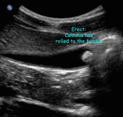 담석증 (Cholelitiasis = GB stone)