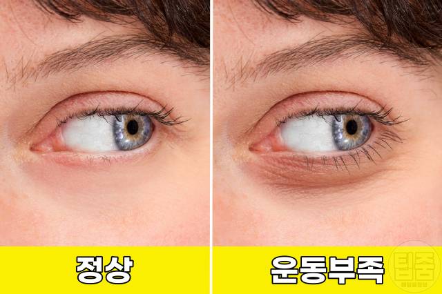 운동부족 증상 병 테스트,눈밑 붓기