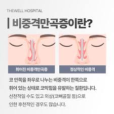 비중격 교정술 증상 및 진단 방법