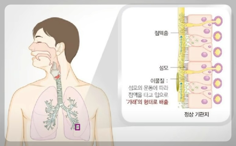 호흡기 질환: 가래- 생기는 원인, 색깔별 증상과 질병, 대처법과 가래 없애는 법.
