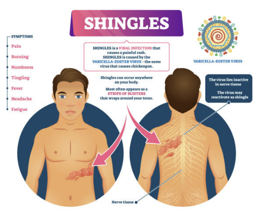 대상포진 예방접종 가격(최저가) 초기증상 치료방법 총정리