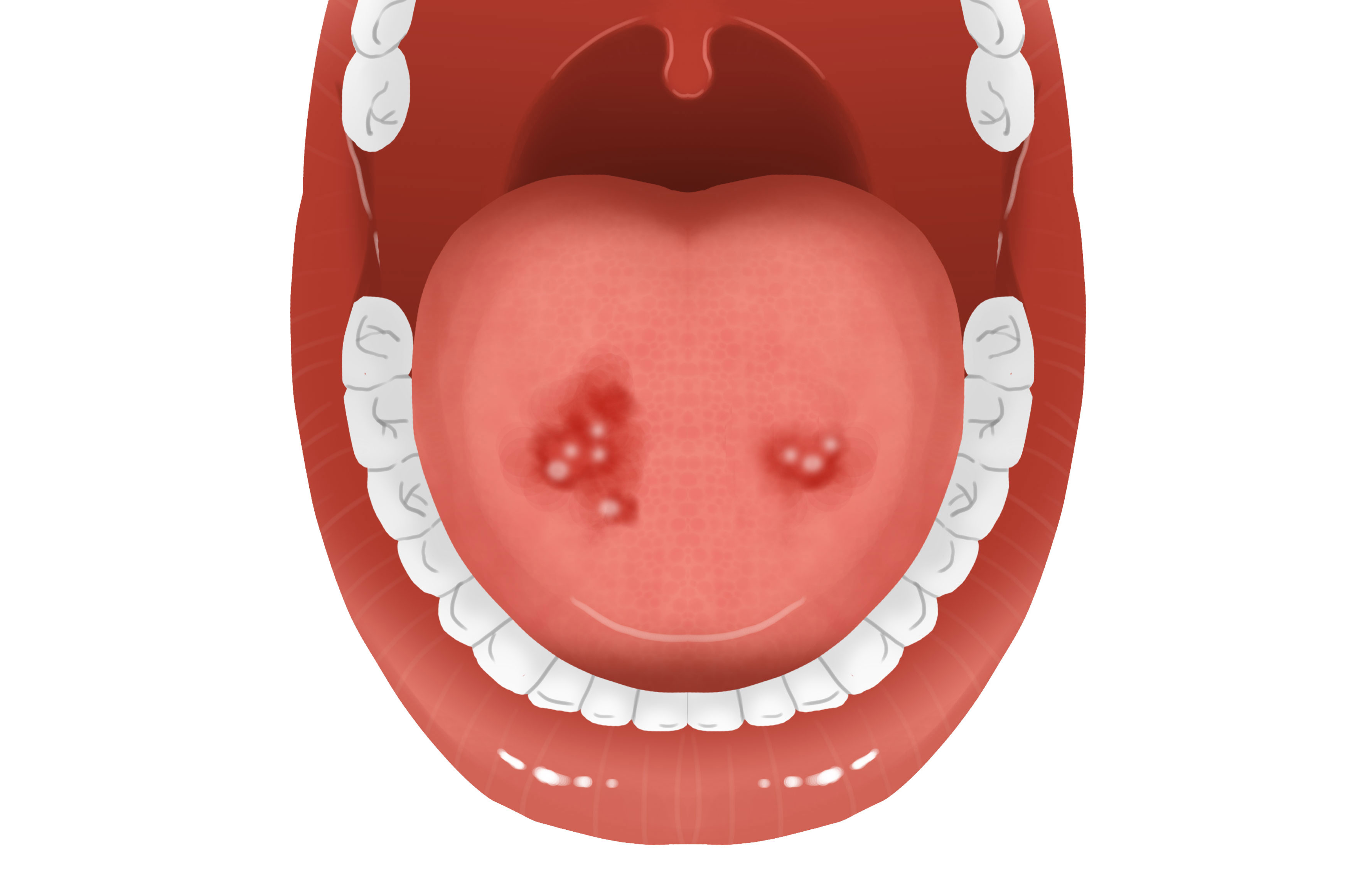 혓바늘이 돋는 이유 원인과 혓바늘 없애는 방법 꿀 치료법 자주돋는 현상 