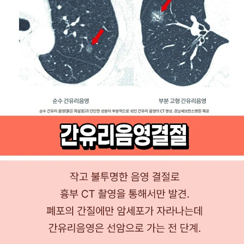 간유리음영결절