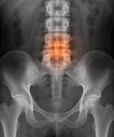 척추관 협착증 운동법과 치료방법