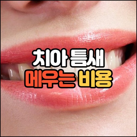 치아 틈새 메우기 비용